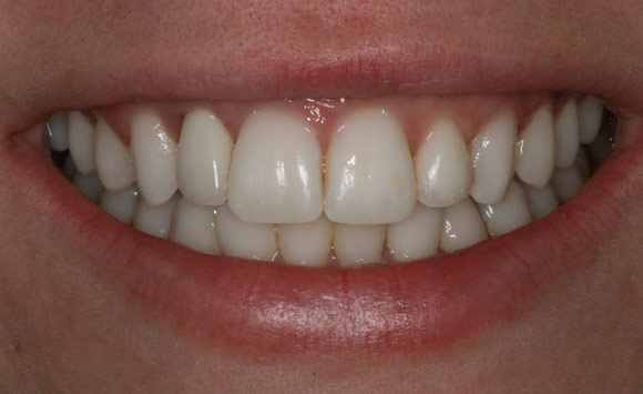 Dental Implants required patient after the dental implant