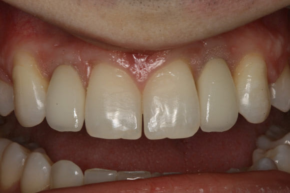 restorative dentistry after image of a patient