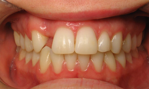 Best dental implant treatment in Phoenix , AZ before image of a patient