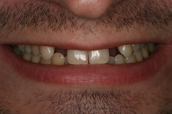 Best dental implant treatment before image of a patient Phoenix , AZ