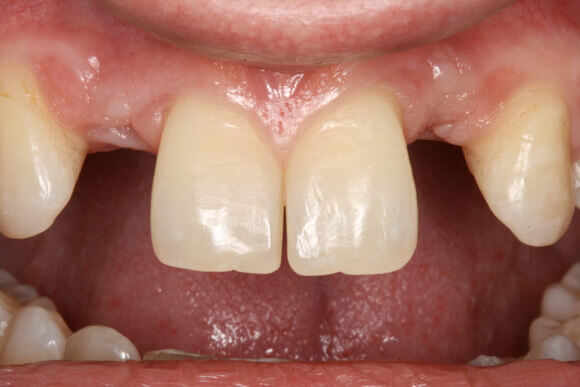 Before the tooth restoration with implant actual patient imagePhoenix , AZ