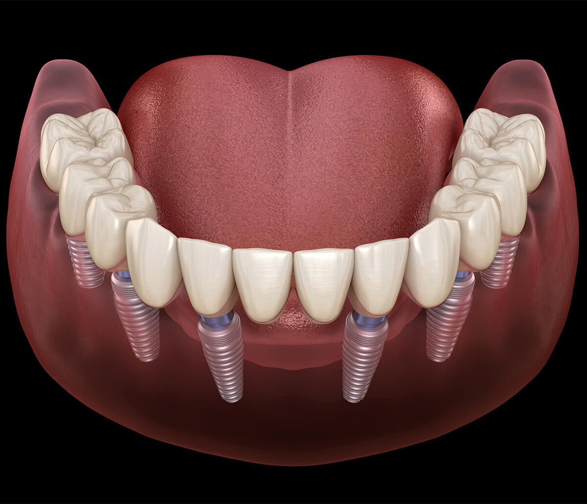 Implant Supported Dentures in Phoenix AZ Area