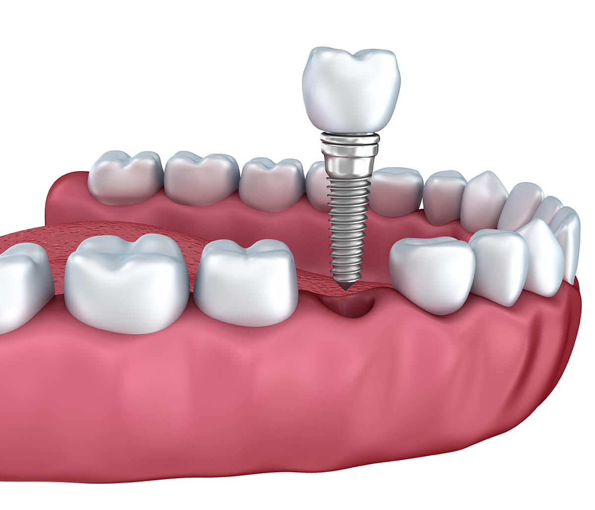 Dental Implant Recovery Process in Phoenix AZ Area