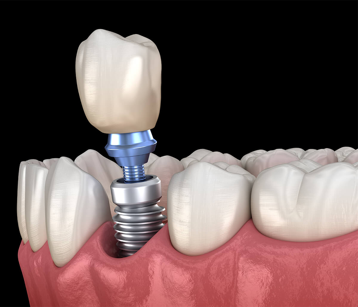 Are Dental Implants Safe in Phoenix AZ Area